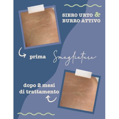 Tratamiento de estrías